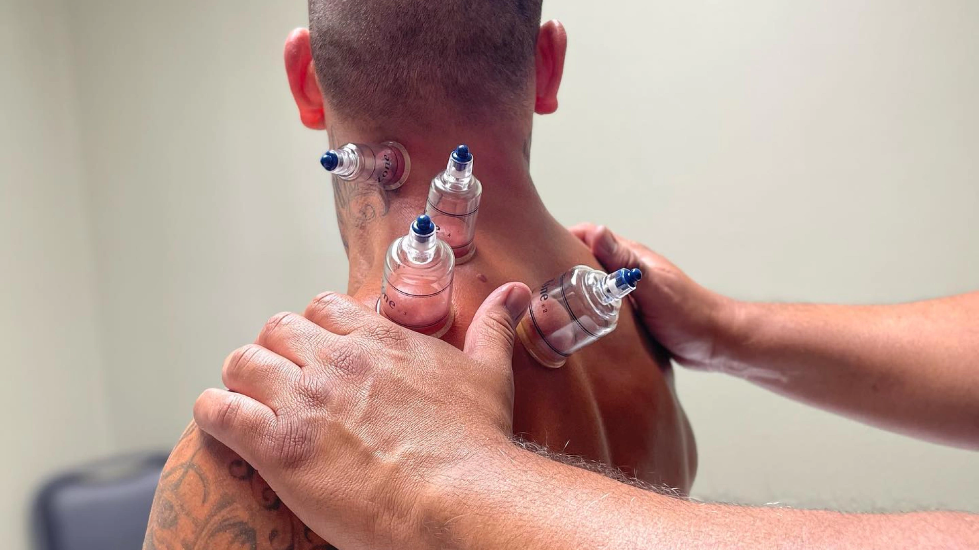 hero cupping therapy session
